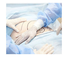 Laparoscopic Hysterectomy Surgery Ahmedabad